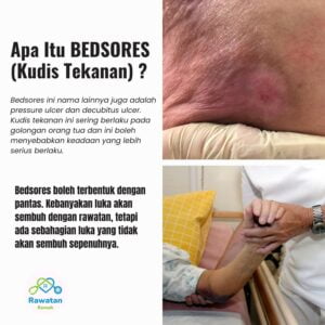 Apa itu Bedsores (Kudis Tekanan)?