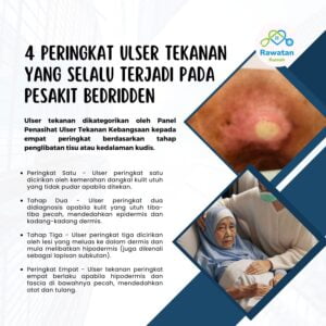 4 Peringkat Ulser Tekanan