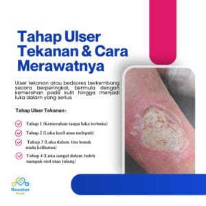 Tahap Ulser Tekanan & Cara Merawatnya